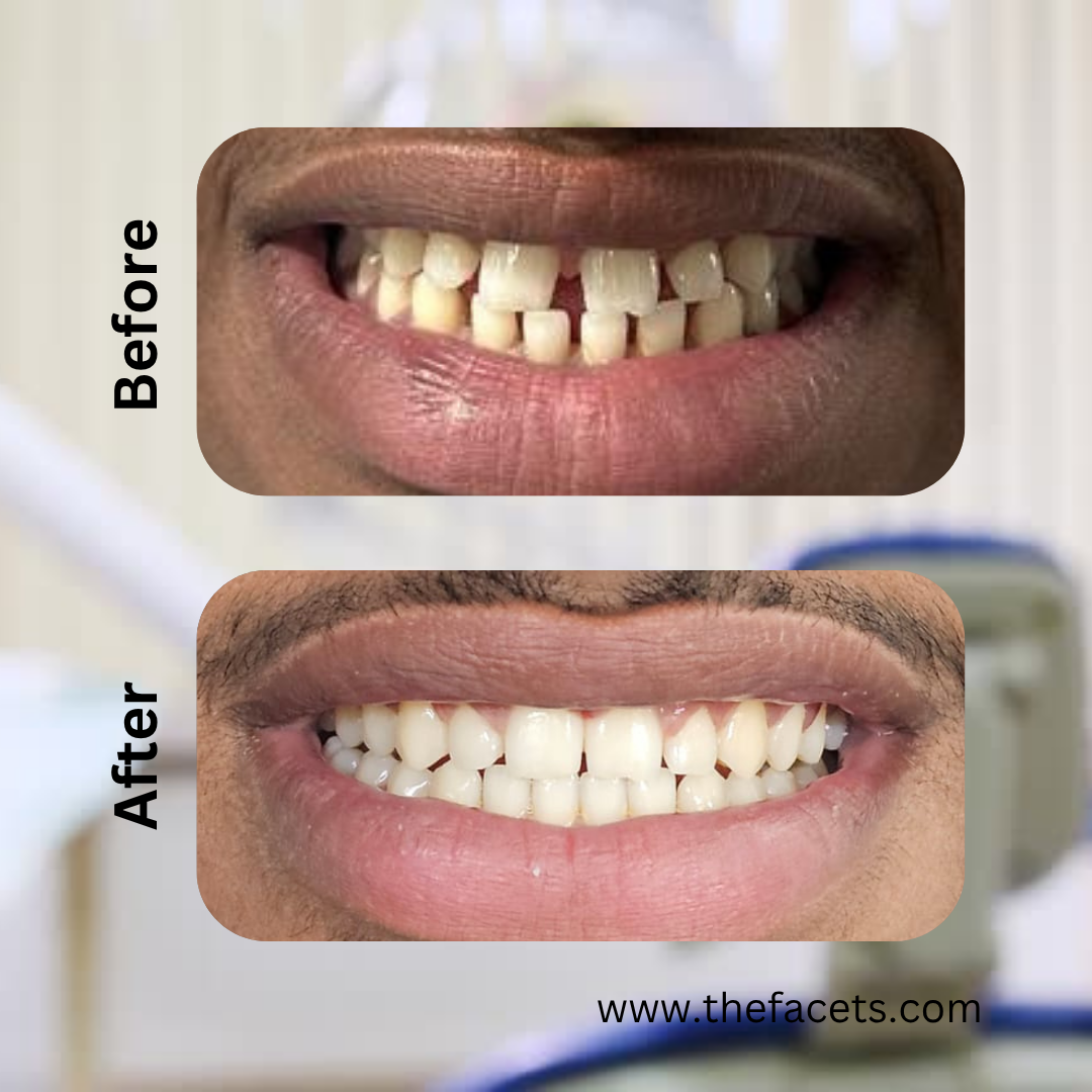 Before After Result 1